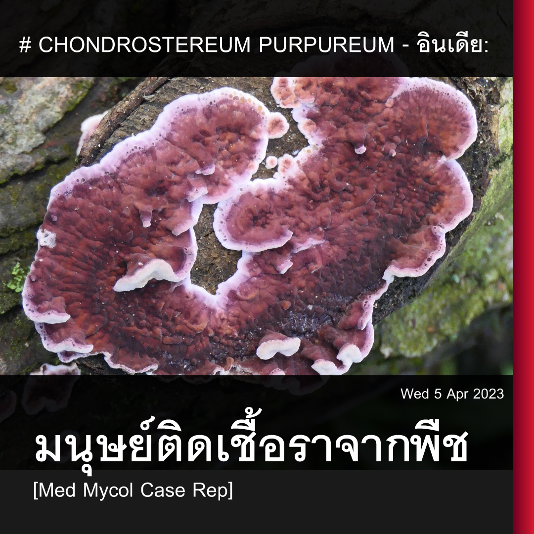 # CHONDROSTEREUM PURPUREUM - อินเดีย: มนุษย์ติดเชื้อราจากพืช [Med Mycol Case Rep]